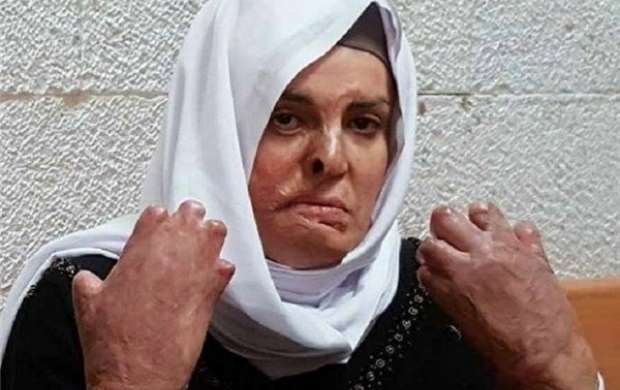 حبس زن اسیر فلسطینی با ۵۰ درصد سوختگی